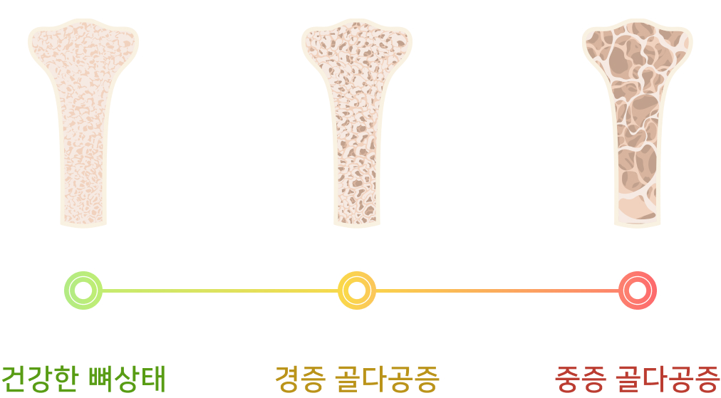 건강한 뼈 상태에서 경증 골다공증, 중증 골다공증으로 진행되는 골밀도 변화